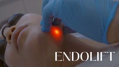 EndoliftX®